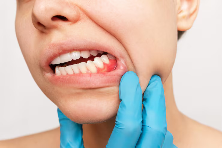 Gum Disease Treatment