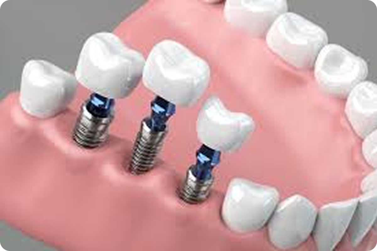 Multiple Tooth Implants