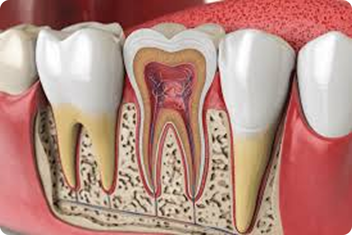 Re-Root Canal Treatment