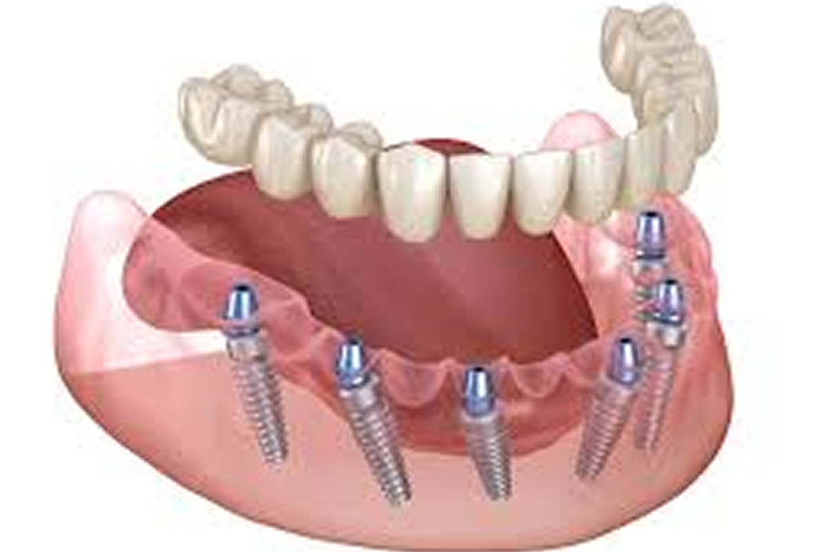 Full Mouth Dental Implants