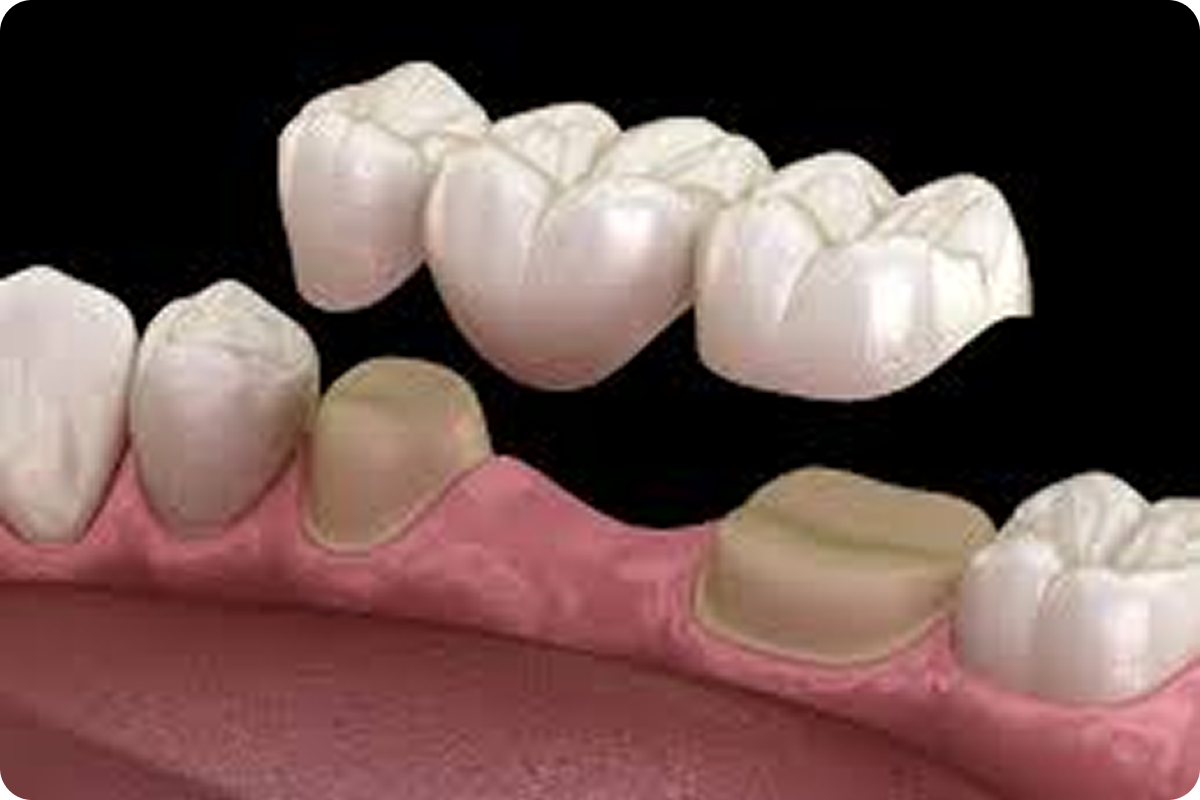Dental Bridges