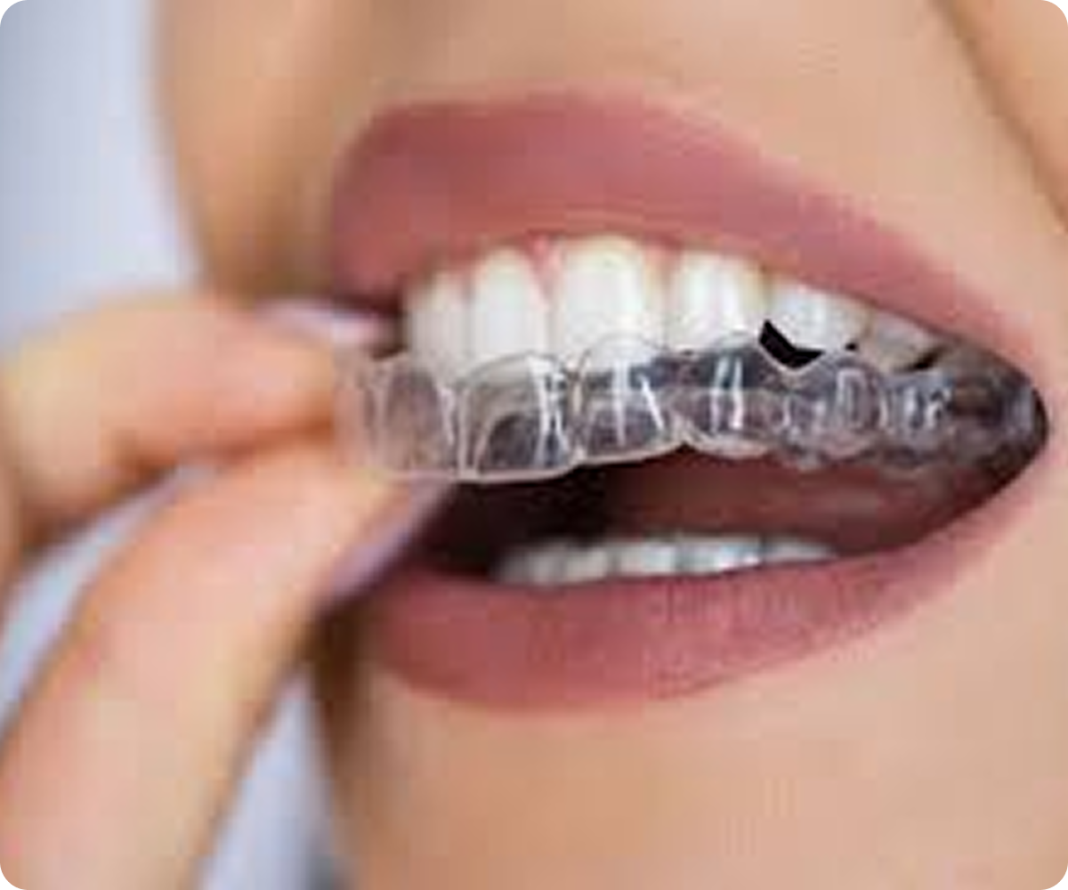 Braces