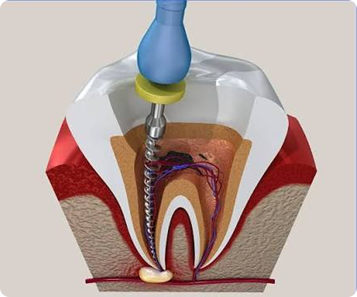 Root Canal Treatment