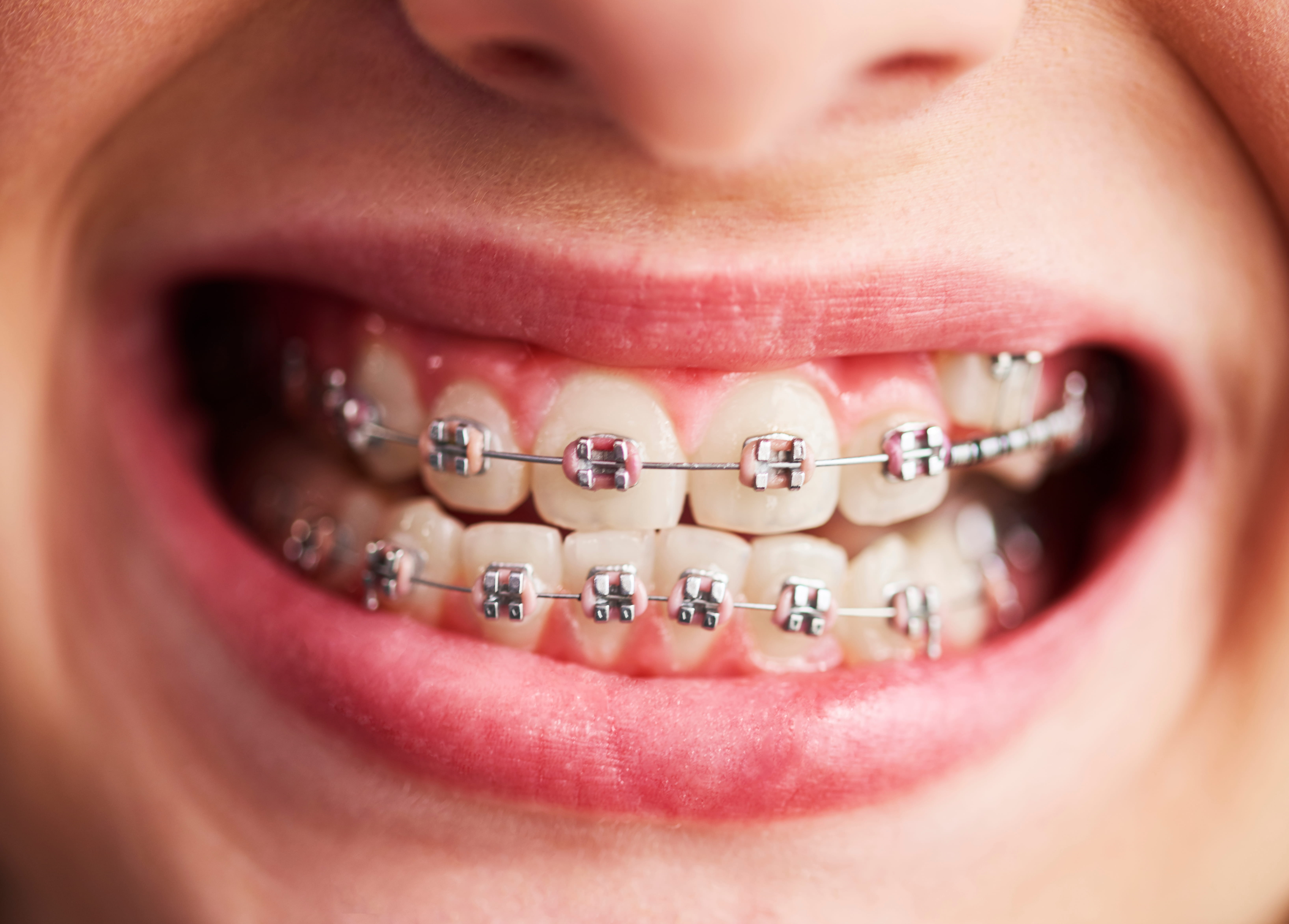 Metal Braces Metal Braces